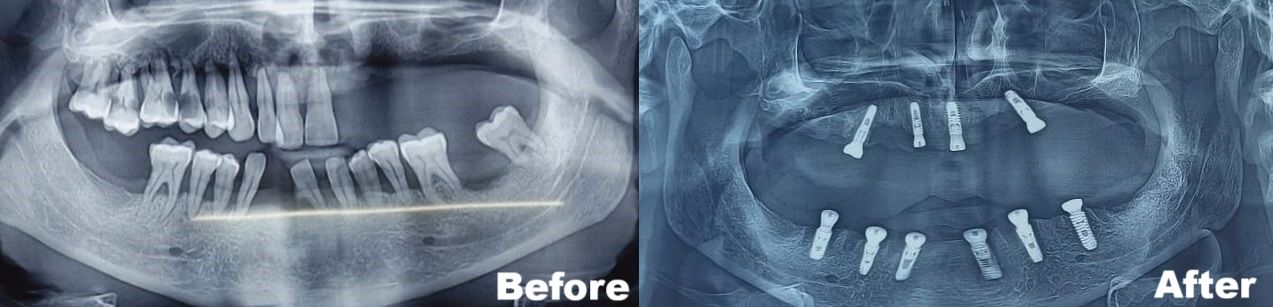 All on 4 and All on 6 dental implants by Guided Implant Surgery - Copy.jpeg
