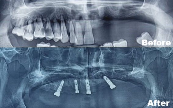 All-on-4-implants by Guided Implant Surgery.jpeg