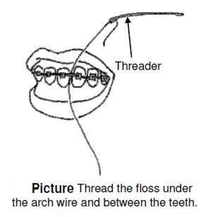flossing with braces.jpg